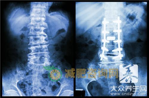 先天性脊柱侧弯的危害是什么？