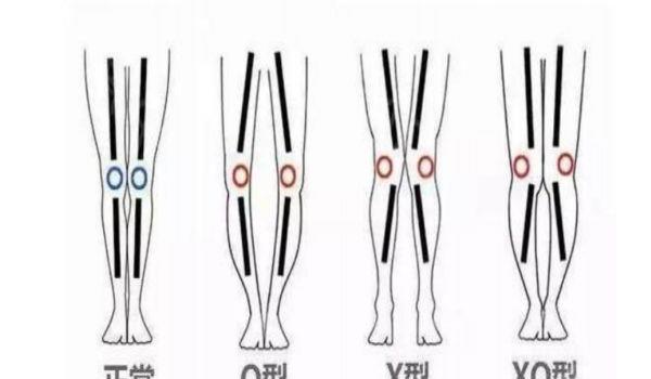 腿型不好看怎么办 如何修正O型腿